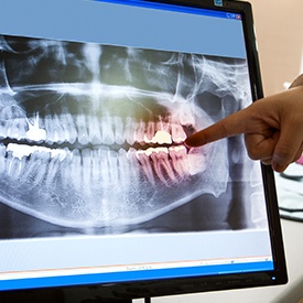 Diigtal dental x-rays on computer