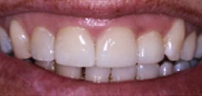 Repaired front teeth following decay