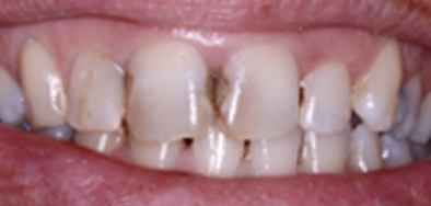 Patient with severe decay between front teeth