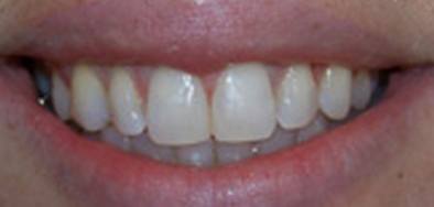 Smile with closed gap between front teeth