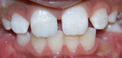 Smile with repaired front tooth