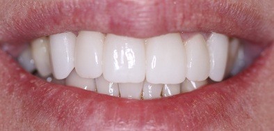 Bright white repaired front teeth