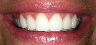 Flawlessly repaired gorgeous front teeth
