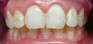Severely damaged and discolored front teeth