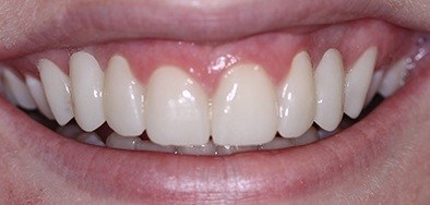 Flawless properly aligned healthy smile