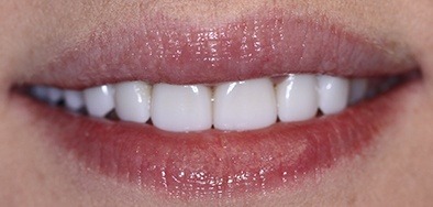 Grogeous white smile after repair