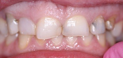 Severely damaged and discolored teeth