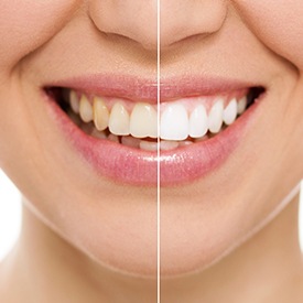 Closeup of teeth half before and half after teeth whitening