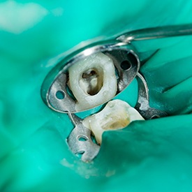 an infected tooth that has been cleaned out
