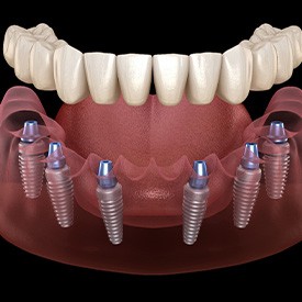 A 3D illustration of an implant denture and its parts