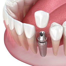 Illustration of single dental implant