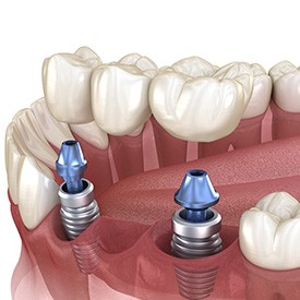 Illustration of an implant bridge