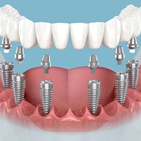 Illustration of an implant denture