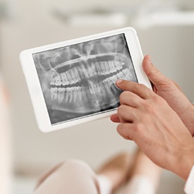 Digital dental x-rays