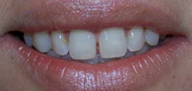 Smile with gap between front teeth