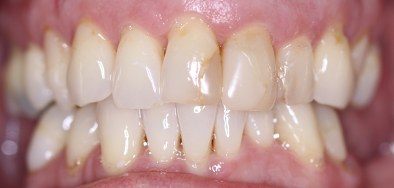 Dark colored, decayed front teeth