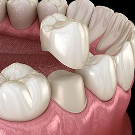 3D illustration of a dental crown capping a prepared tooth