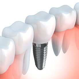 Animation of implant supported dental crown