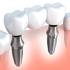 Animation of implant supported fixed bridge