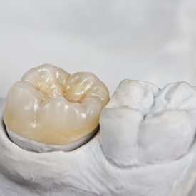 Model smile with dental crown restoration