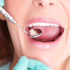 Closeup of smile during dental exam