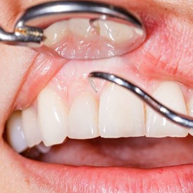 dental cleaning