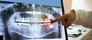 Dental x-rays on computer