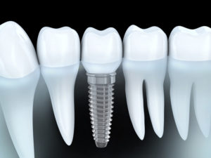 Dental implants in Arnold imitate natural teeth from root to crown. The process at JL Dental  is comfortable, and dental implants last indefinitely.