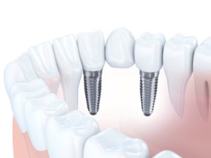 implant-supported bridge