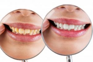 One photo of a woman’s mouth showing stained teeth, another photo of a woman’s mouth showing white teeth