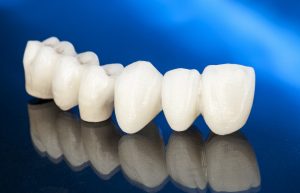 All-ceramic dental bridge in Arnold